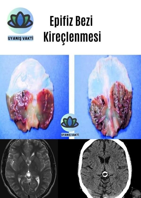 Epifiz Bezi Kireçlenmesini Gidermek: 35 Doğal Yöntem